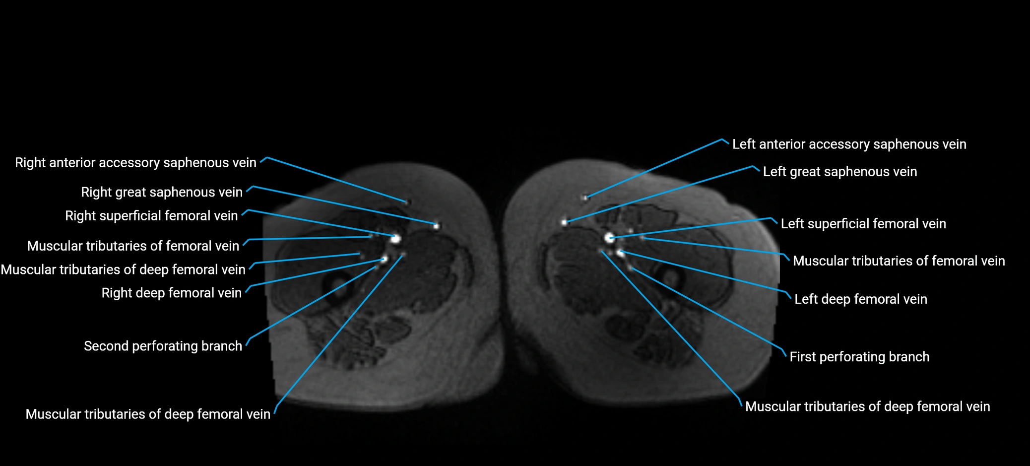 MRV abdomen pelvis & lower limb axial cross sectional anatomy labelled MRI image 225 (1).webp